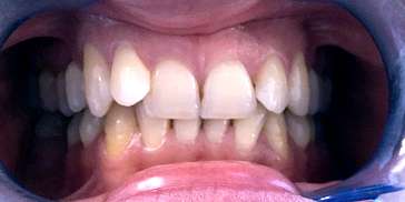 Affollamento dentale: prima