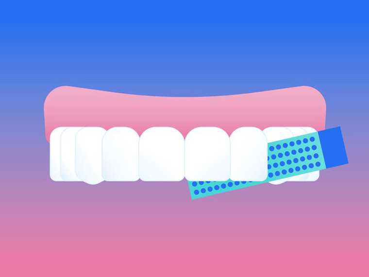 Illustration of IPR or dental stripping