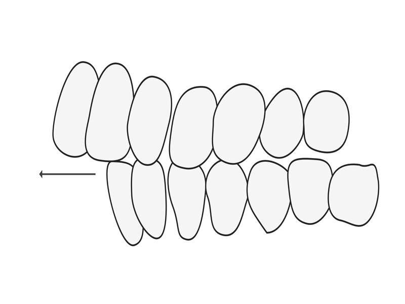 Overjet: denti sporgenti
