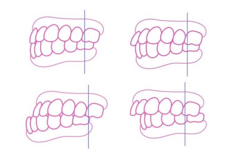 Malocclusione