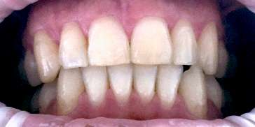 Diastema: dopo