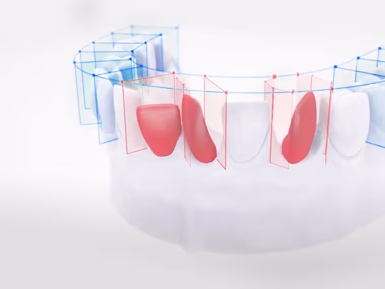 Malocclusione: Correggere i denti mal posizionati