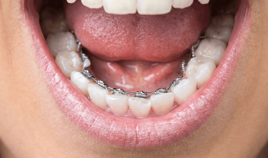 [CRO] Impress Lingual Braces Desktop